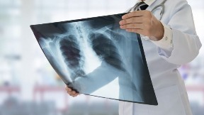 Endemska tuberkuloza